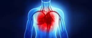 Causes of Heart Attack