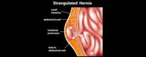Hernias